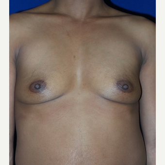 35-44 year old woman treated with Breast Augmentation before 3320037