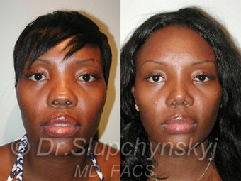Ethnic Rhinoplasty before 1117141