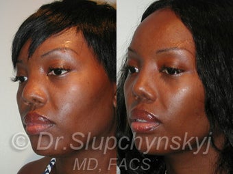 Ethnic Rhinoplasty after 1117141