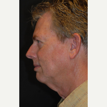60 year old man treated with Facelift before 3839634