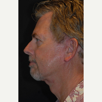 60 year old man treated with Facelift after 3839634