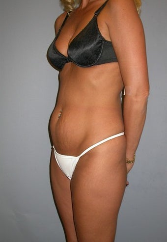 37 year old Tummy Tuck patient before 1316597