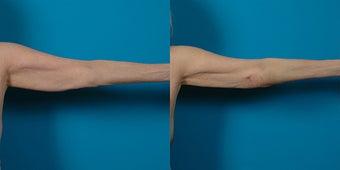 66-year-old woman treated with Liposuction. after 3287634