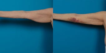 66-year-old woman treated with Liposuction. before 3287634