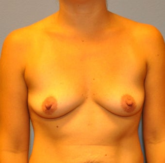 Breast Augmentation, Breast Implants before 1166153