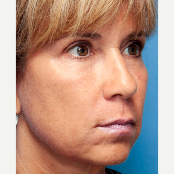 45-54 year old woman treated with INFINI Skin Rejuvenation after 2899588