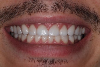 Smile Makeover was a Game Changer for 30-Something Guy after 1013558