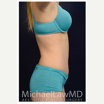 25-34 year old woman treated with Tummy Tuck after 3071079