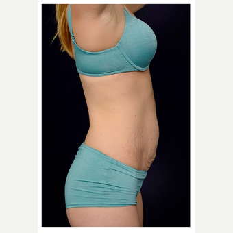 25-34 year old woman treated with Tummy Tuck before 3071079