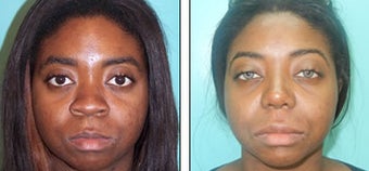 Nose Job- Rhinoplasty before 1116998