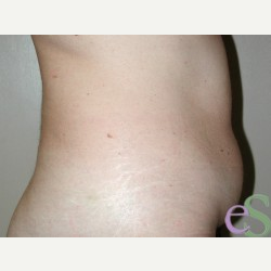 42 year old woman treated with Tummy Tuck before 3484935