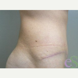 42 year old woman treated with Tummy Tuck after 3484935