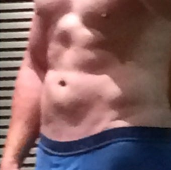 25-34 year old man treated for Smart Lipo after 1479505
