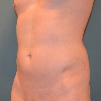 25-34 year old man treated for Smart Lipo before 1479505