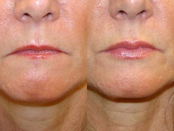 Fuller Lips with Lip Injections before 1358684