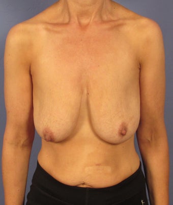 Breast Rejuvenation in a 45 year old before 1506302