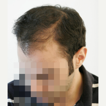 25-34 year old man treated with FUE Hair Transplant before 3068869