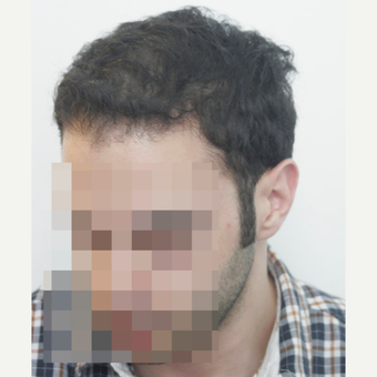 25-34 year old man treated with FUE Hair Transplant after 3068869