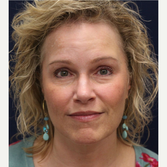 45-54 year old woman treated with Bellafill before 3237144