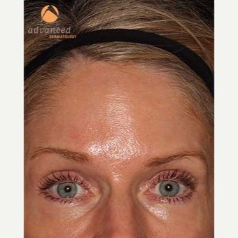 35-44 year old woman treated with CO2 Laser after 1757026
