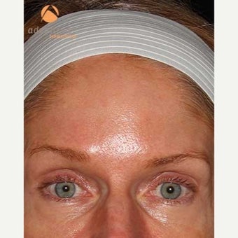 35-44 year old woman treated with CO2 Laser before 1757026