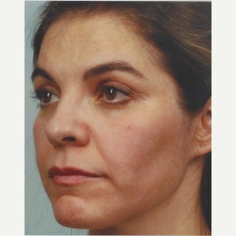 45-54 year old woman treated with Melasma Treatment with Obagi Nu Derm Skin Transformation System after 2581687
