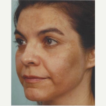 45-54 year old woman treated with Melasma Treatment with Obagi Nu Derm Skin Transformation System before 2581687