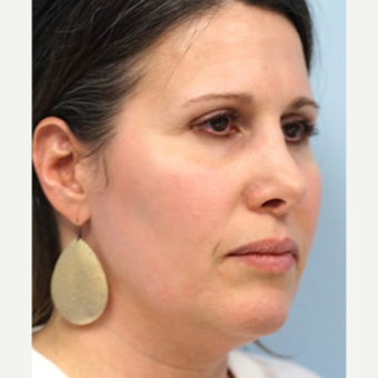 45-54 year old woman treated with Revision Rhinoplasty before 3686798