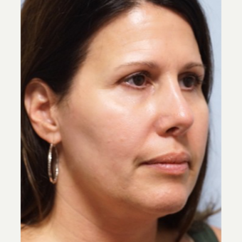 45-54 year old woman treated with Revision Rhinoplasty after 3686798