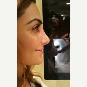 25-34 year old woman treated with Rhinoplasty after 3687116