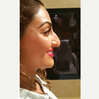 25-34 year old woman treated with Rhinoplasty before 3687116
