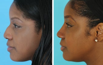 African American rhinoplasty before 1675498