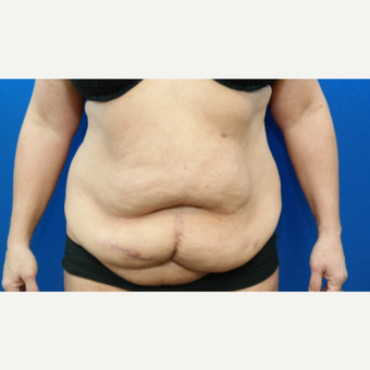 45-54 year old woman treated with Tummy Tuck, Scar Revision, and Hernia Repair before 3104906