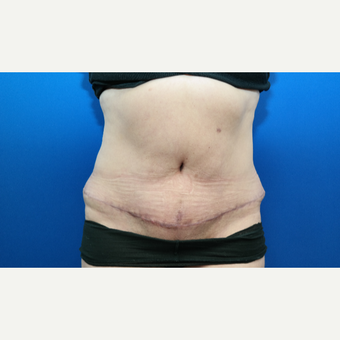 45-54 year old woman treated with Tummy Tuck, Scar Revision, and Hernia Repair after 3104906