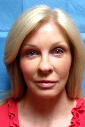 Facelift, Browlift with Autologous Fat Transfer as marked after 1289651