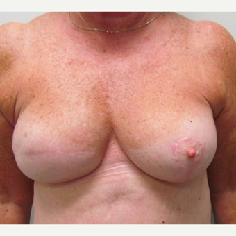 Breast Reconstruction for This 74 Year Old Woman after 3387171