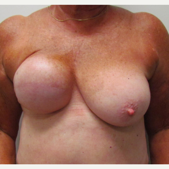 Breast Reconstruction for This 74 Year Old Woman before 3387171