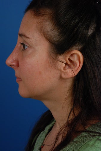 Revision rhinoplasty patient after 2 prior rhinoplasties 828357