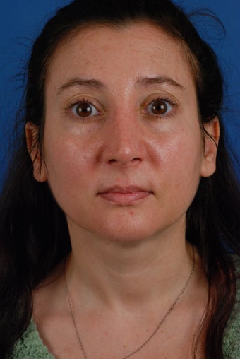 Revision rhinoplasty patient after 2 prior rhinoplasties after 828357