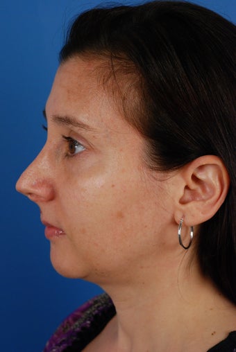 Revision rhinoplasty patient after 2 prior rhinoplasties 828357
