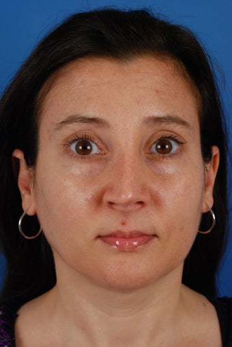Revision rhinoplasty patient after 2 prior rhinoplasties before 828357