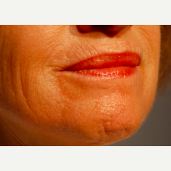 55-64 year old woman treated with CO2 Laser before 2167117
