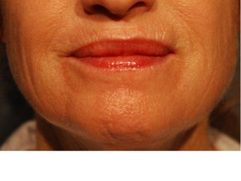 55-64 year old woman treated with CO2 Laser 2167117