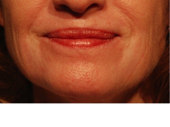 55-64 year old woman treated with CO2 Laser 2167117