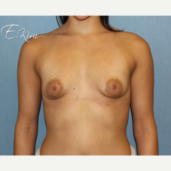 25-34 year old woman treated with Breast Lift with Implants before 3663403