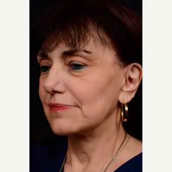 55-64 year old woman treated with Facelift after 3776503