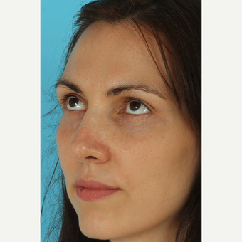 25-34 year old woman treated with Revision Rhinoplasty after 3630125
