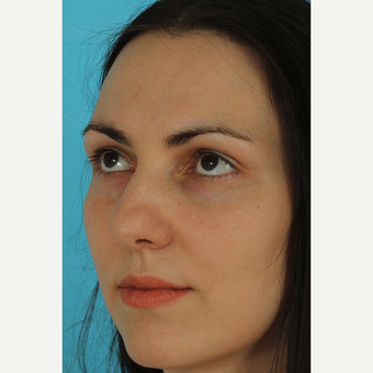 25-34 year old woman treated with Revision Rhinoplasty before 3630125
