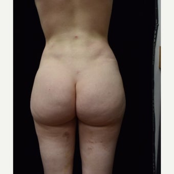 18-24 year old woman treated with Brazilian Butt Lift Revision after 2548258
