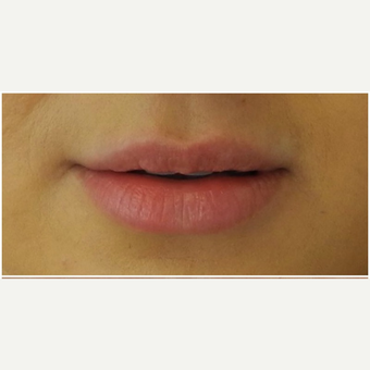 25-34 year old woman treated with Juvederm before 3300586